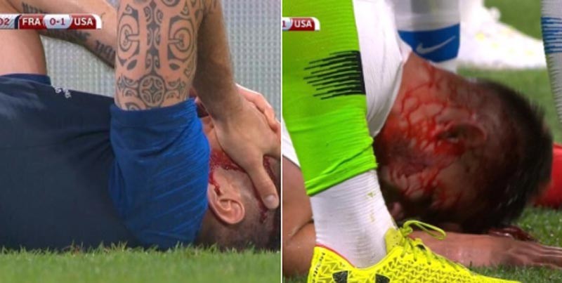 Hrozivo vyzerajúce zranenie Girouda v zápase s USA. Útočník Francúzska mal dokrvavenú celú hlavu! (VIDEO)
