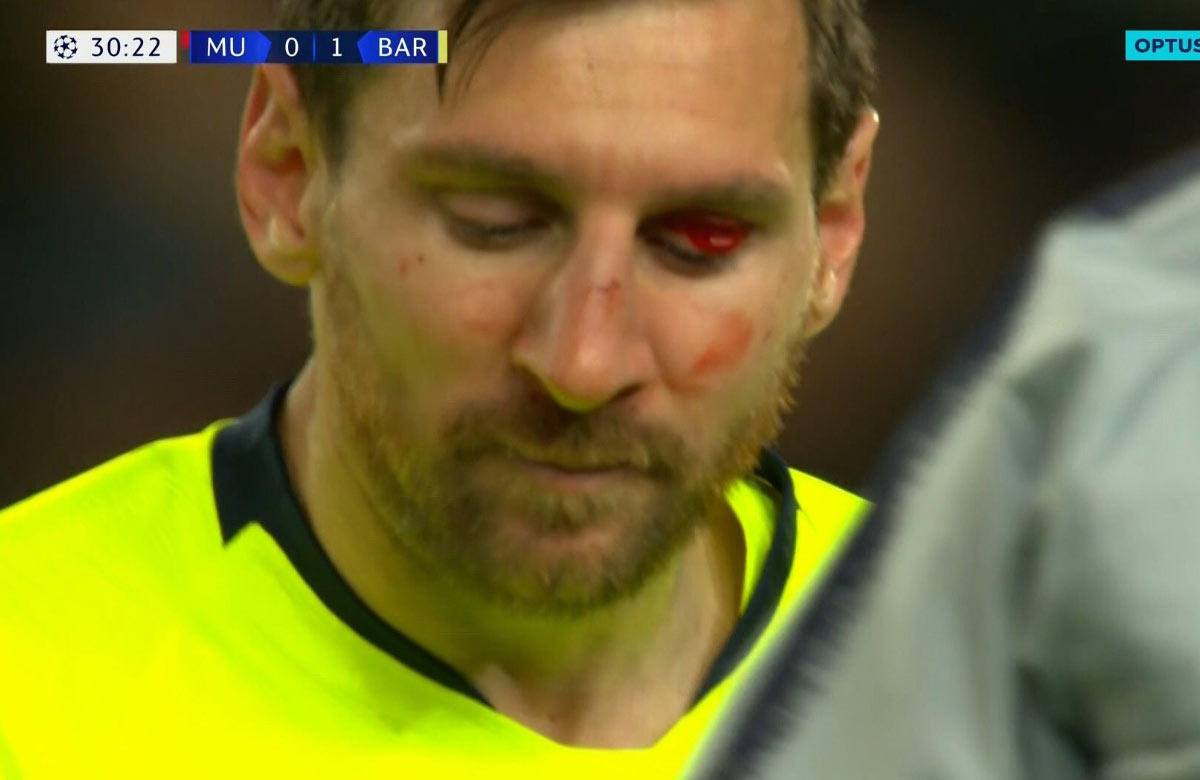 Ako Chris Smalling knonautoval Lionela Messiho, ktorý skončil s dokrvavenou tvárou! (VIDEO)
