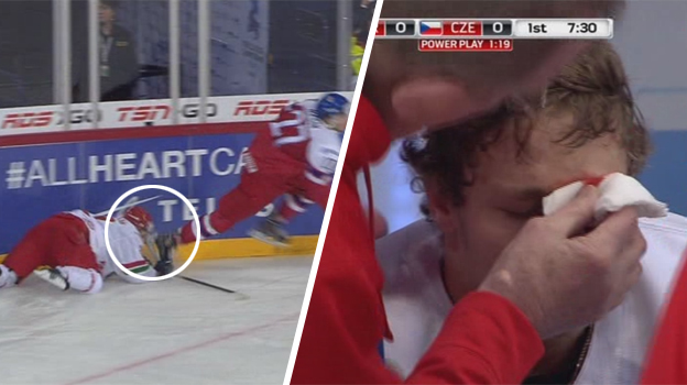Mladý Bielorus takmer prišiel o oko! Čech mu nešťastne korčuľou rozrezal tvár (VIDEO)